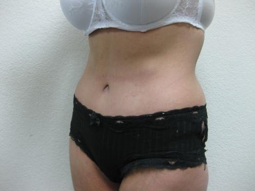 Tummy Tuck - Patient 2 -  After 3