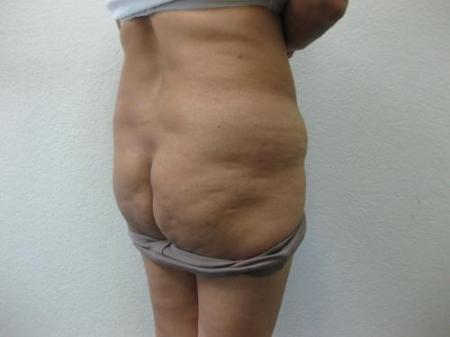 Brazilian Butt Lift - Patient 4 - Before Image 2