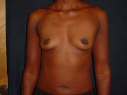 Breast Augmentation - Patient 14 - Before 1
