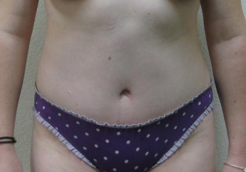 Tummy Tuck - Patient 15 -  After 1