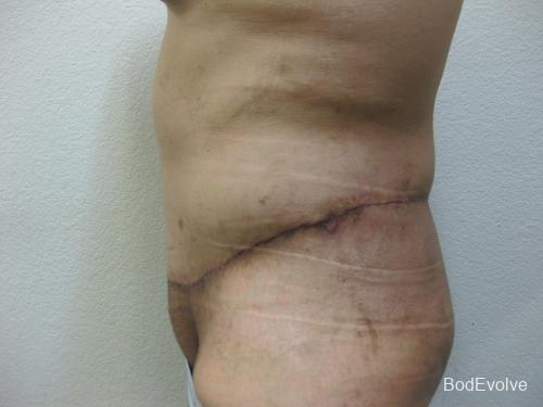 Patient 3 - Cosmetic Surgery After Massive Weight Loss -  After 3