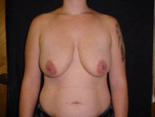 Breast Augmentation with Lift - Patient 5 - Before