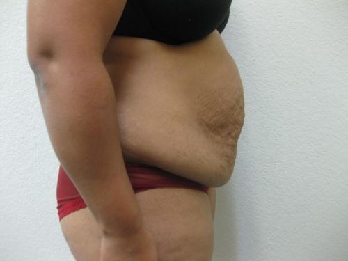Tummy Tuck - Patient 14 - Before and After 3