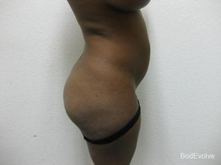 Brazilian Butt Lift - Patient 1 - Before Image 3