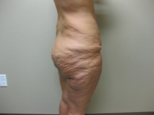 Patient 25 - Cosmetic Surgery After Massive Weight Loss - Before 6