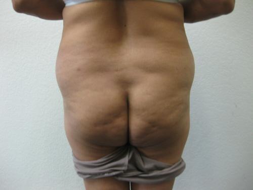 Brazilian Butt Lift - Patient 4 - Before