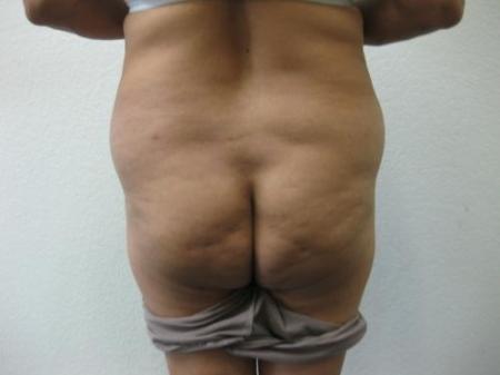 Brazilian Butt Lift - Patient 4 - Before Image 1