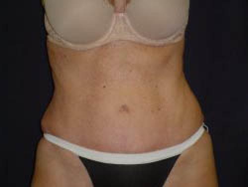 Tummy Tuck - Patient 8 -  After 1
