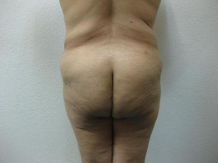 Body Lift - Patient 7 - Before Image 4