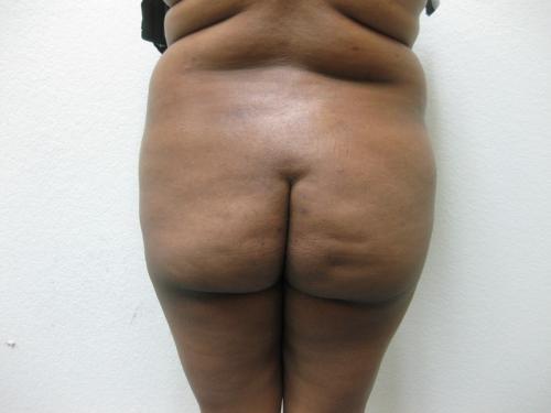 Brazilian Butt Lift - Patient 5 - After 