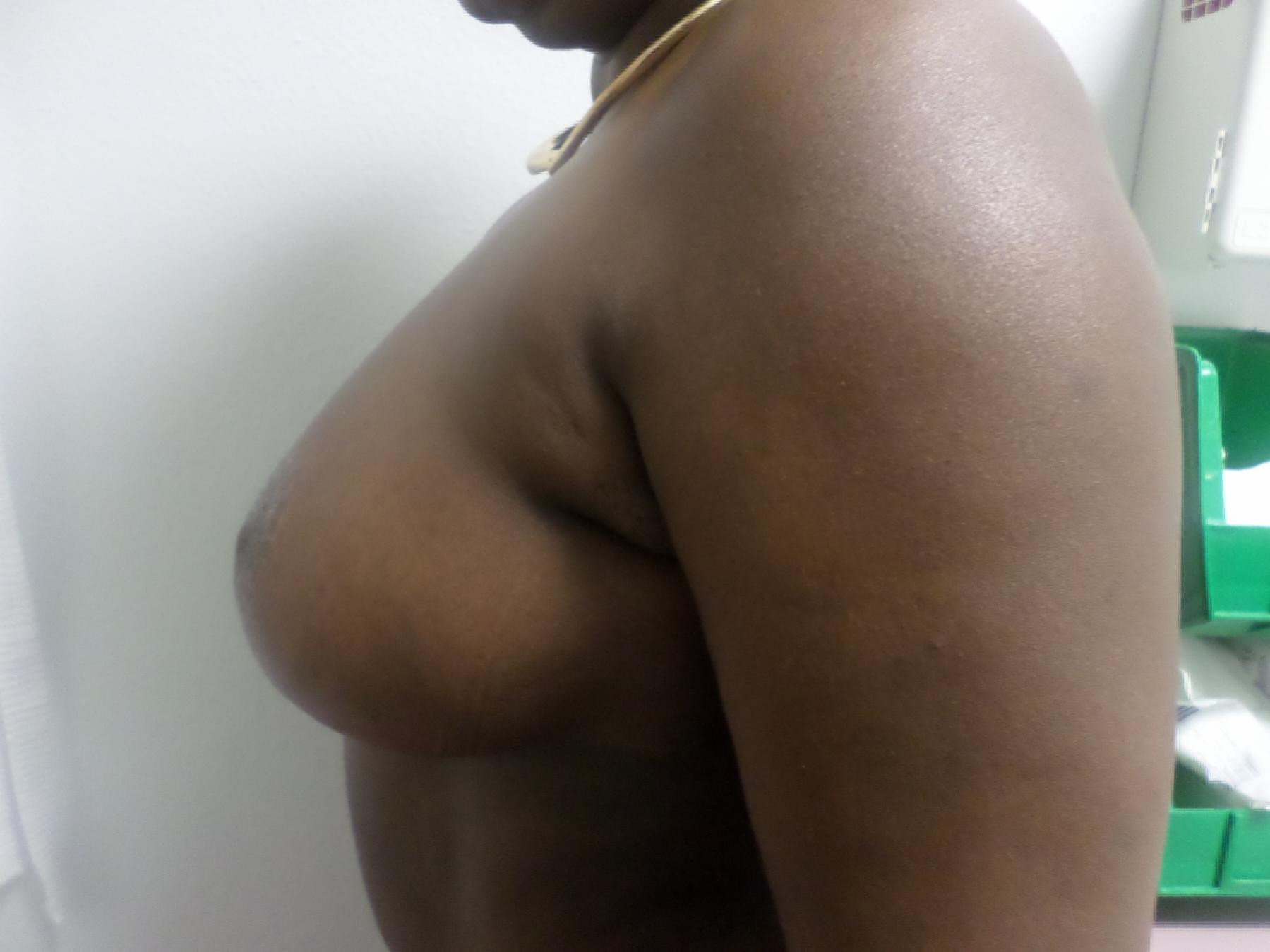 Breast Reduction: Patient 15 - After 2