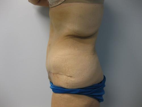 Patient 15 - Cosmetic Surgery After Massive Weight Loss -  After 3