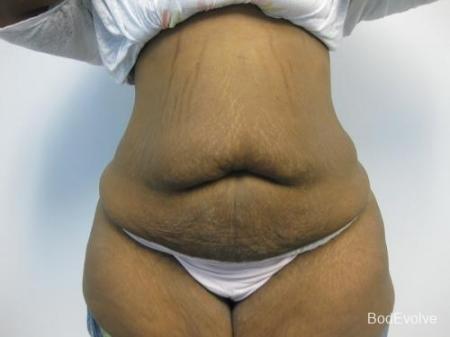 Patient 2 - Cosmetic Surgery After Massive Weight Loss - Before