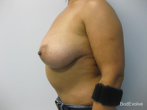 Breast Reduction - Patient 1 - Before 4