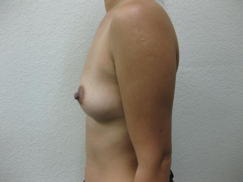 Breast Augmentation - Patient 3 - Before 3