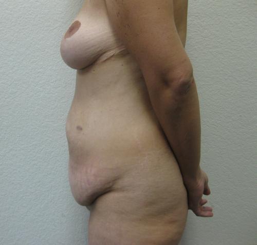 Patient 23 - Cosmetic Surgery After Massive Weight Loss - Before and After 3