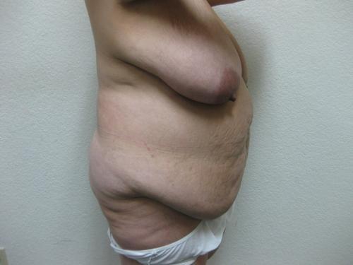 Patient 12 - Cosmetic Surgery After Massive Weight Loss - Before 4