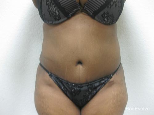 Tummy Tuck - Patient 1 - After 