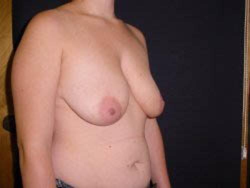 Breast Augmentation with Lift - Patient 5 - Before 2