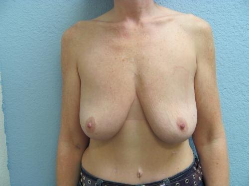 Breast Augmentation with Lift - Patient 10 - Before 1
