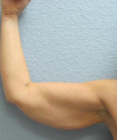 Arm Lift Surgery - Patient 3 - Before Image 5