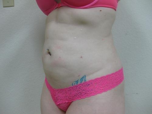 Liposuction - Patient 5 -  After 4