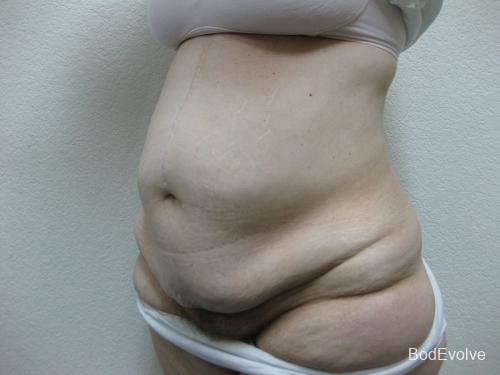 Patient 4 - Cosmetic Surgery After Massive Weight Loss - Before 2