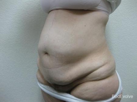 Patient 4 - Cosmetic Surgery After Massive Weight Loss - Before Image 2