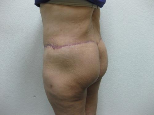 Patient 14 - Cosmetic Surgery After Massive Weight Loss -  After 5