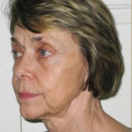 Facelift - Patient 2 - Before Image 3