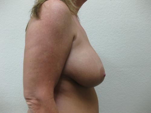 Breast Reduction - Patient 3 - Before and After 3