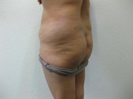 Brazilian Butt Lift - Patient 4 - Before Image 3