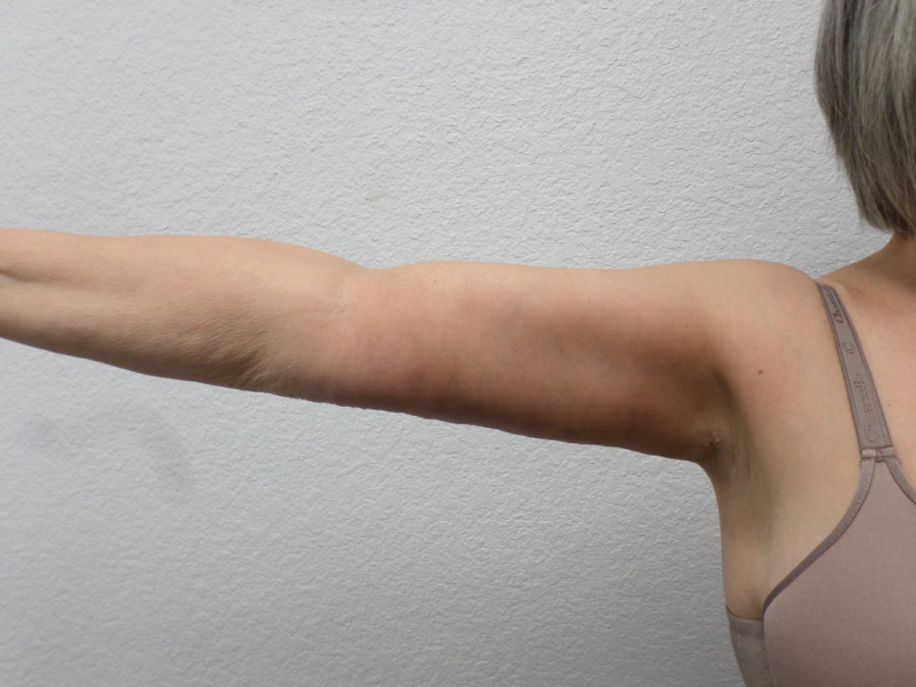 Arm Lift: Patient 9 - After 4