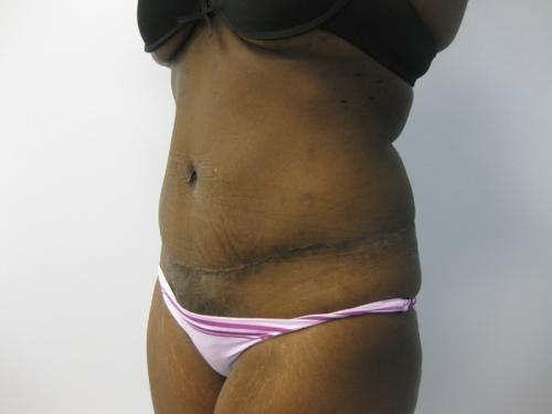 Patient 13 - Cosmetic Surgery After Massive Weight Loss -  After 2