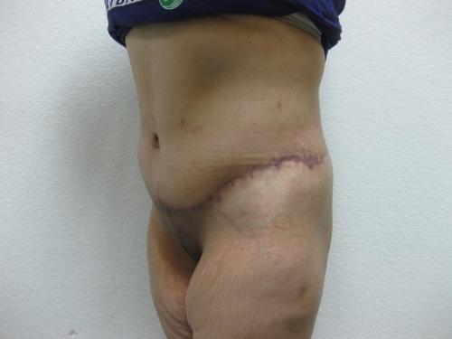 Body Lift - Patient 7 - After 6