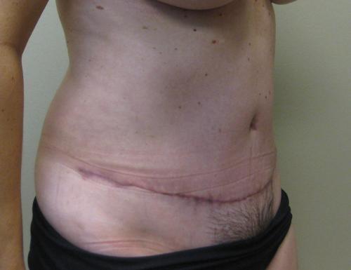 Tummy Tuck - Patient 6 -  After 6
