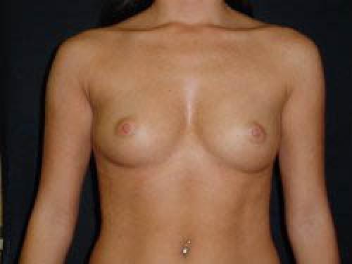 Breast Augmentation - Patient 12 - Before 1