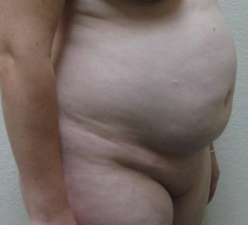 Tummy Tuck - Patient 15 - Before 2