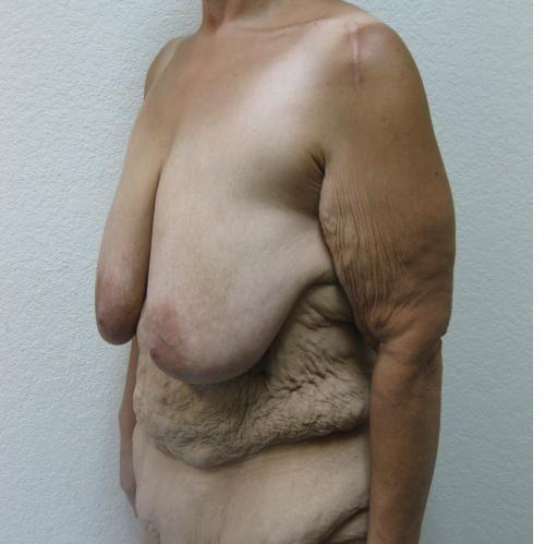Patient 22 - Cosmetic Surgery After Massive Weight Loss - Before 2