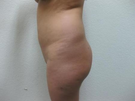 Brazilian Butt Lift - Patient 3 - After Image 3