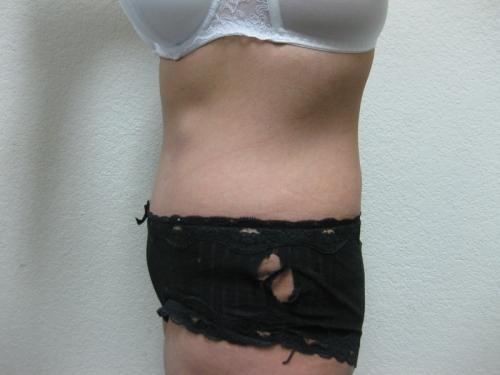 Tummy Tuck - Patient 2 -  After 4