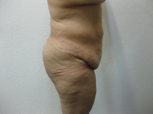 Patient 14 - Cosmetic Surgery After Massive Weight Loss - Before 2