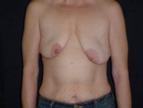 Breast Augmentation with Lift - Patient 7 - Before 1