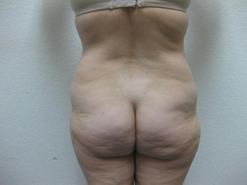 Liposuction - Patient 3 - Before 4