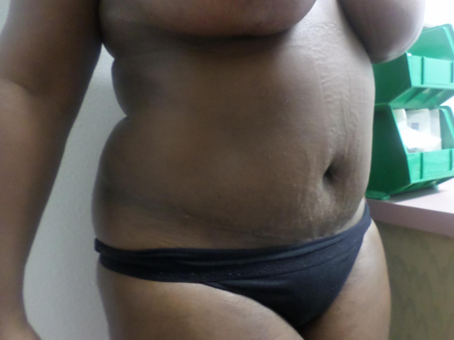 Tummy Tuck: Patient 30 - After 2
