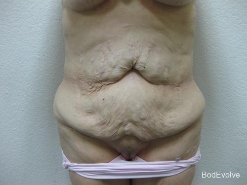 Patient 5 - Cosmetic Surgery After Massive Weight Loss - Before 1