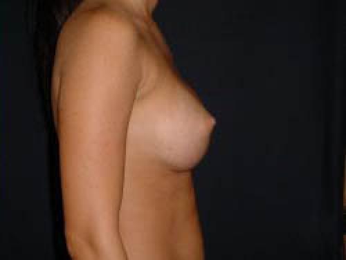 Breast Augmentation - Patient 12 -  After 3