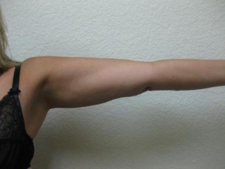 Liposuction - Patient 4 - After Image 2