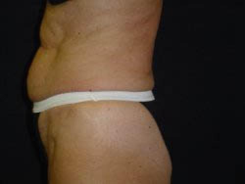 Tummy Tuck - Patient 8 - Before and After 3