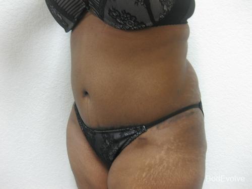 Tummy Tuck - Patient 1 -  After 3